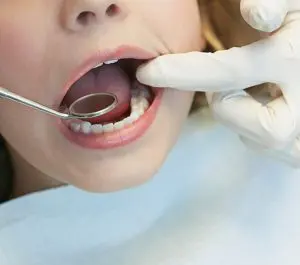 Dental Sealants