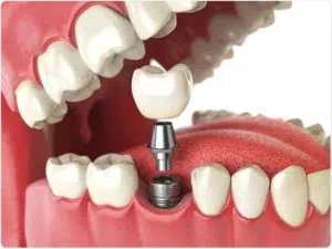 dental implants in garland tx