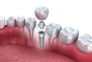 Example of dental implants in Garland, TX, supervised by Dr. Dooley DDS
