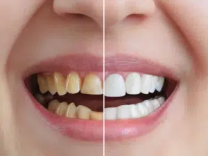 A patient before and after dental crowns in Garland, TX