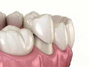 Example of a dental crown as placed by SCOTT DOOLEY DDS in Garland, TX