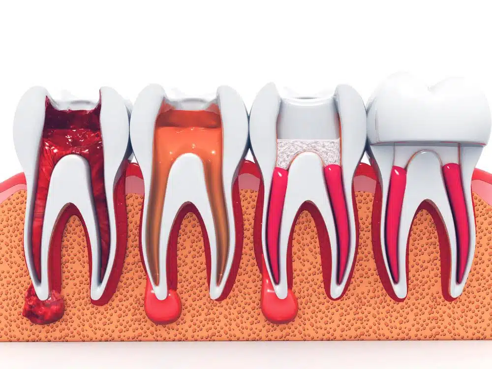 An illustration showing the stages of a root canal treatment