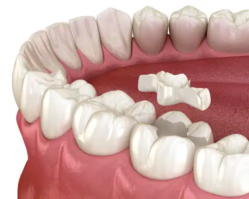 Example of inlays - a type of dental restoration - as placed by our Garland dentist