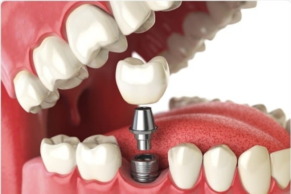 A Permanent Base For Replacement Teeth